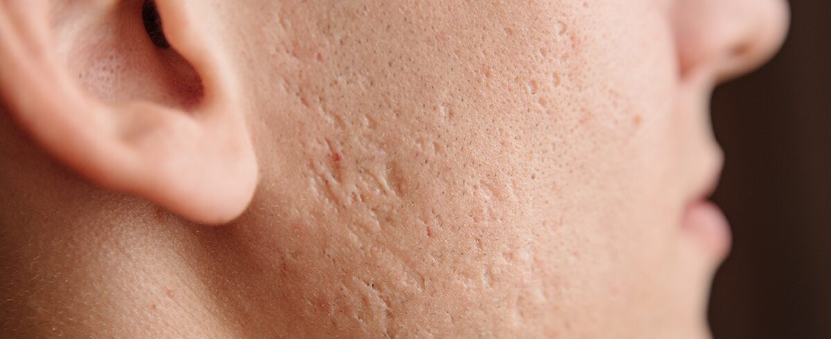 detersione acne