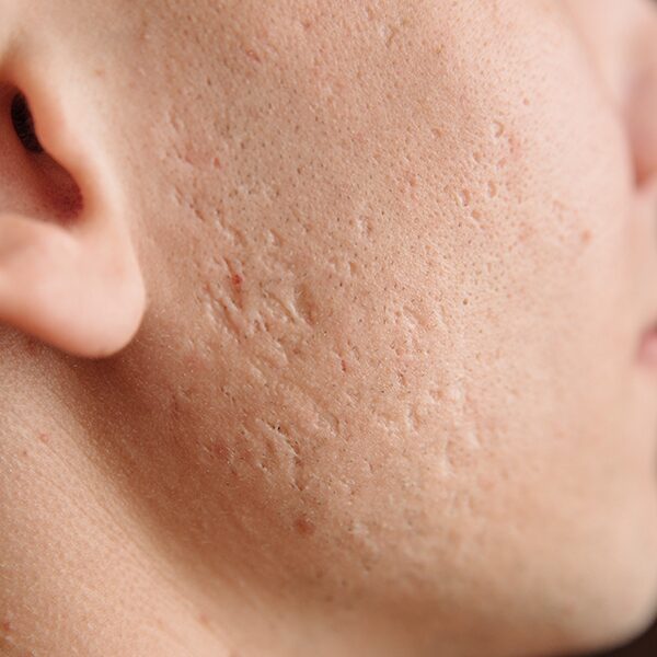 protezione pelle acne
