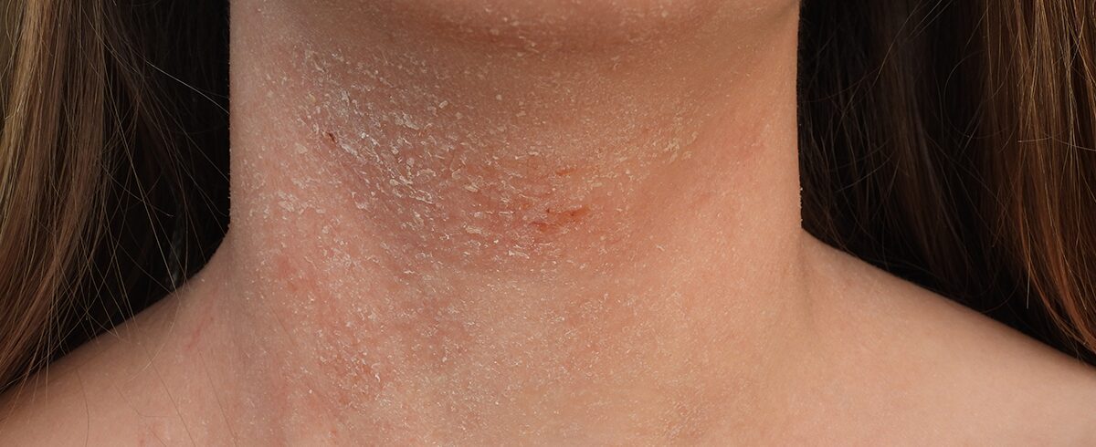 dermatite malattia pelle