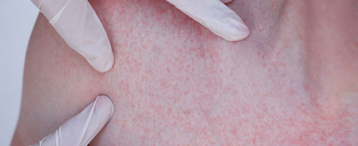 Malattie della pelle più comuni: cause e rimedi