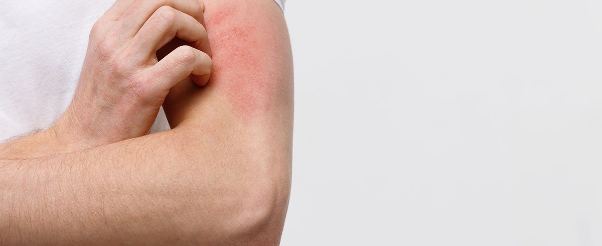 Eczema: cos’è, quali sono le cause più comuni e come si tratta