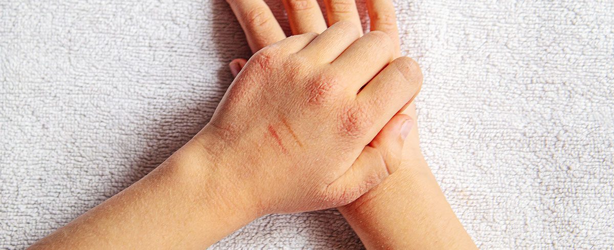 Come riconoscere l’eczema atopico, il più diffuso