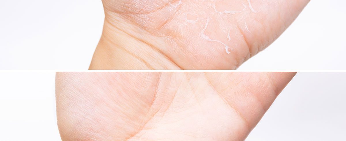 L’eczema disidrosico: la dermatite che colpisce mani e piedi