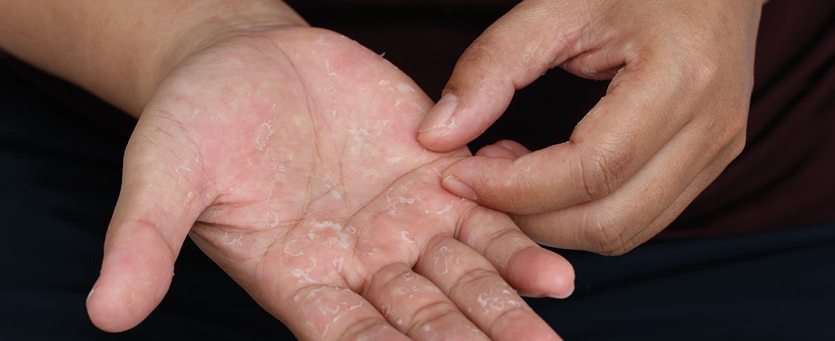 I diversi tipi di eczema: come riconoscerli