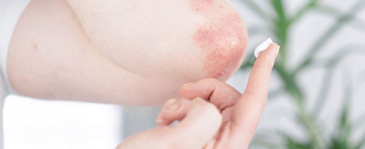 Eczema sul viso e le mani: curare la dermatite senza imbarazzo