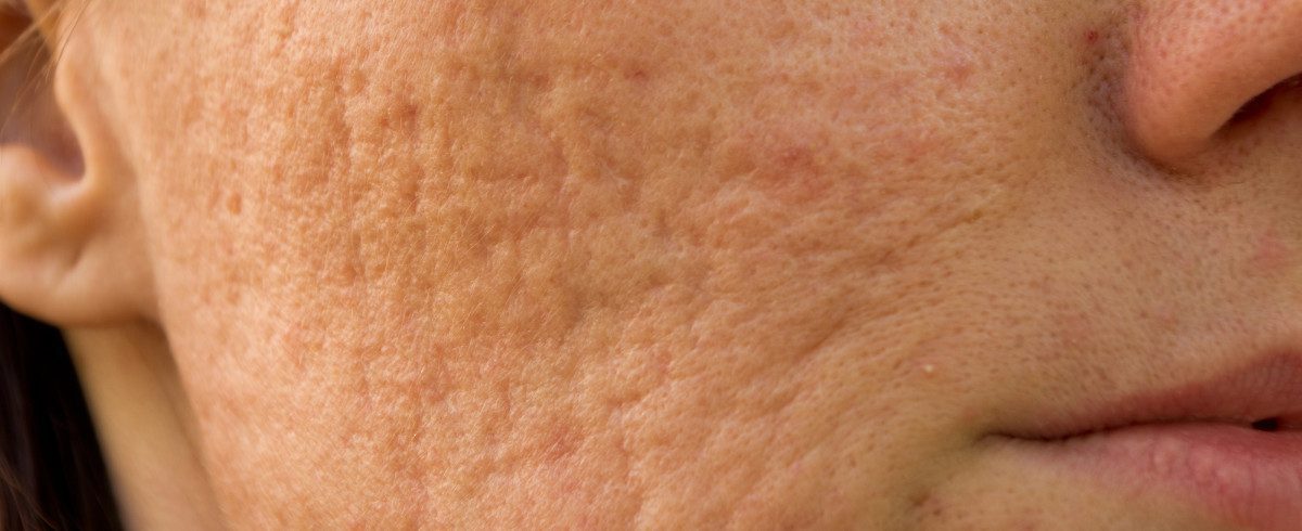 Cicatrici da acne: come evitare i segni indelebili sulla pelle