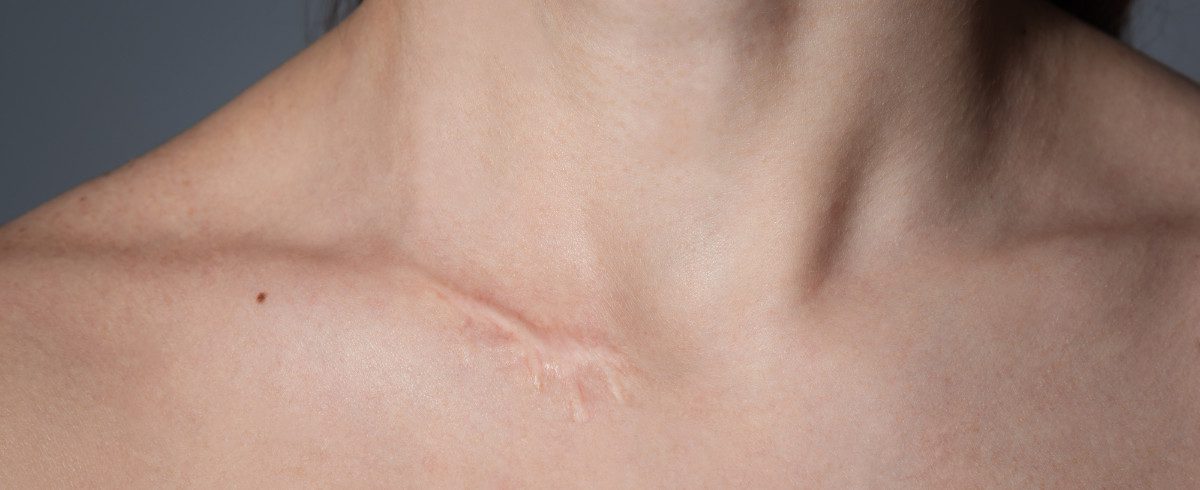 Come si curano cicatrici e cheloidi?