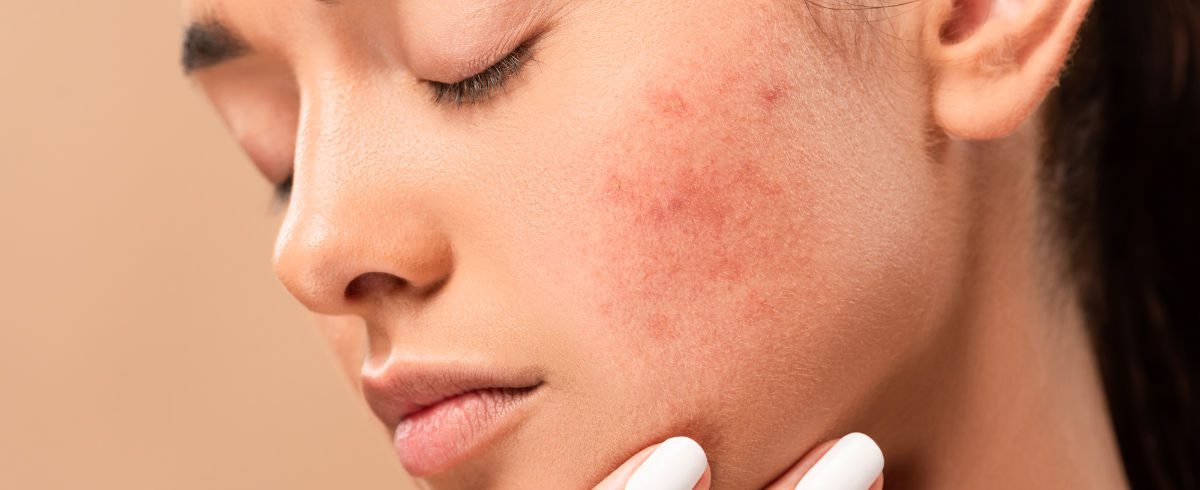 Cicatrici da acne cosa sono e come trattarle